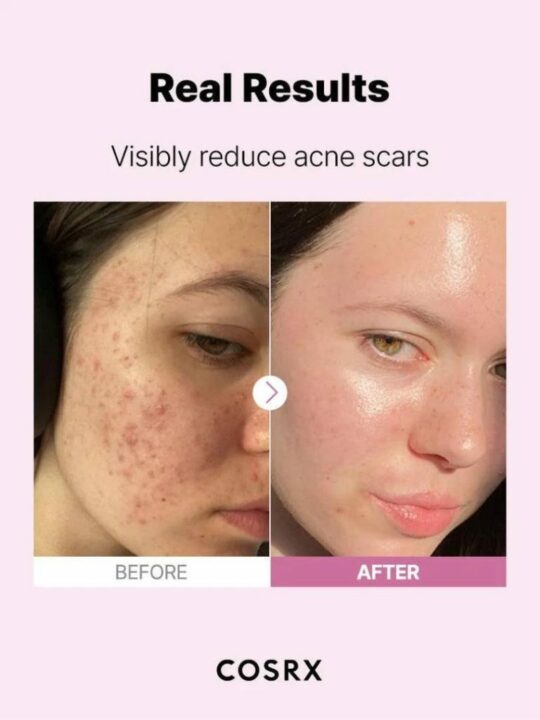 COSRX The Niacinamide 15 Serum – Ορός με νιασιναμίδη για καταπολέμηση της ακμής - 20 ml